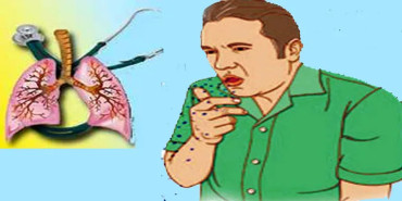 नेपालमा ३२ हजार क्षयरोगी उपचारबाट वञ्चित