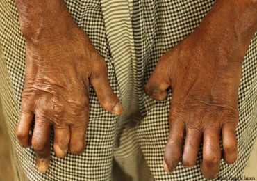 आज ७१ औँ विश्व कुष्ठरोग दिवस मनाइँदै