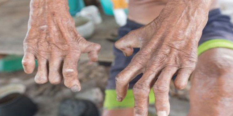 आज विश्व कुष्ठरोग दिवस मनाइँदै