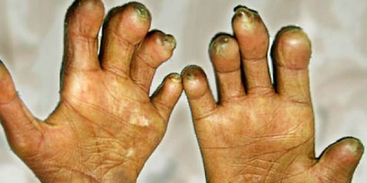 नेपालमा सबैभन्दा बढी नयाँ कुष्ठरोगका बिरामी मधेशमा