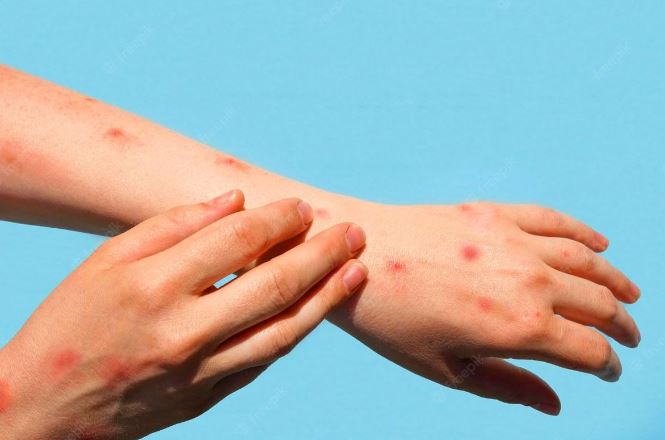 भारतमा टोमाटो फ्लुको सङ्क्रमण बढ्दै, नेपालमा पनि जोखिम